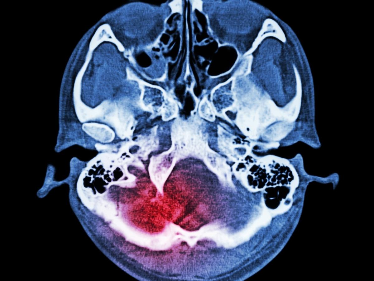 Brain injury scan